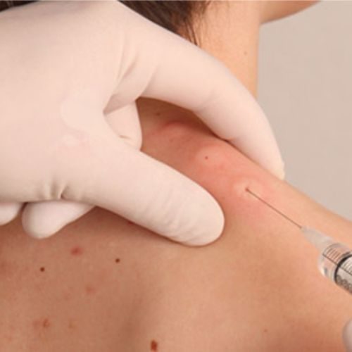 Terapia neural